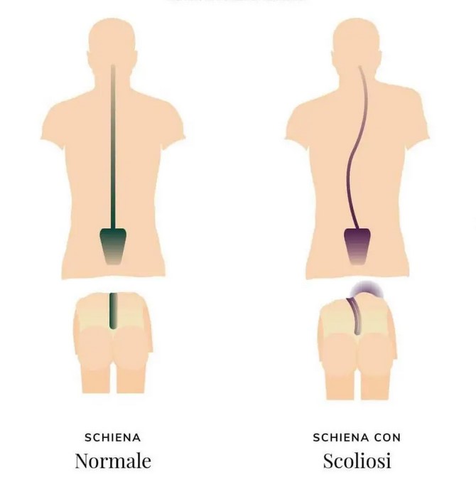 La scoliosi